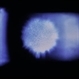 Wilson's Disease Wilson's Disease