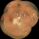 SILICONE OIL FILLED VITRECTOMISED EYE STATUS POST PARS PLANA VITRECTOMY WITH SILICONE OIL INFUSION IN A CASE OF RHEGMATOGENOUS RETINAL DETACHMENT