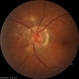 Peripapillary CNV