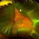 Choroidal Detachment Choroidal Detachment