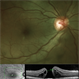 Traumatic Macular Hole with OCT