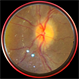 Disc Edema