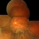 Tractional and Rhegmatogenous Retinal Detachment Tractional and Rhegmatogenous Retinal Detachment