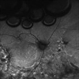 Pseudophakic RRD, S/P Buckle/Vit. w/ Residual Gas Fish Eggs OD Pseudophakic RRD, S/P Buckle/Vit. w/ Residual Gas Fish Eggs OD