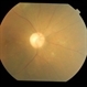 Dengue Retinitis Healed With Optic Atrophy