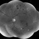 Red free Proliferative DR