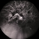 CNVM / Cholesterolemia