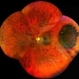 Choroidal-Nevus Choroidal-Nevus