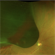 Choroidal Melanoma Choroidal Melanoma