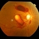Premacular Hemorrhage in Acute Myeloid Leukemia