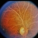 Hyperlipidemia