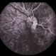 Preretinal Vascular Loop