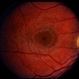 Solar Retinopathy / Familial Solar Retinopathy / Familial