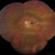 High Myopia with Posterior staphyloma High Myopia with Posterior staphyloma