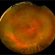 Acute Retinal Necrosis secondary to Herpes Zoster Ophthalmicus Acute Retinal Necrosis secondary to Herpes Zoster Ophthalmicus