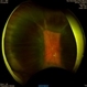 Choroidal Effusion Choroidal Effusion