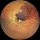 Branch Retinal Vein Occlusion with  Macular Edema. Branch Retinal Vein Occlusion with  Macular Edema.