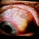 Scleromalacia Perforans