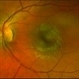 02 Unilateral Acute Idiopathic Maculopathy (UAIM) - Pseudocolor Photograph OS 02 Unilateral Acute Idiopathic Maculopathy (UAIM) - Pseudocolor Photograph OS
