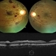 Dengue-Associated-Retinopathy (Anaemic Retinopathy) Dengue-Associated-Retinopathy (Anaemic Retinopathy)