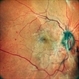 TRACTIONAL RETINAL DETACHMENT TRACTIONAL RETINAL DETACHMENT