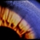 Wilson's Disease Wilson's Disease