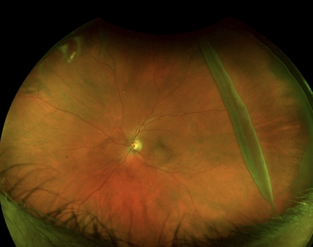 Giant Retinal Tear Left Eye Retina Image Bank