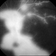 Lupus Retinopathy Lupus Retinopathy