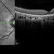 Serpiginous Choroidal Atrophy Serpiginous Choroidal Atrophy
