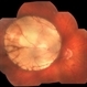 Coloboma Coloboma