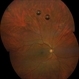 Intravitreal Air Bubbles after anti-VEGF Injection