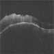 TB Granuloma