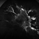 Severe Proliferative Diabetic Retinopathy