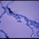 Pigmented Pre-retinal Membrane Pigmented Pre-retinal Membrane