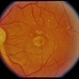 ARMD / Subfoveal CNVM ARMD / Subfoveal CNVM