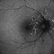 Fundus Autofluorescence  Showing Angioid Streaks with Regressing CNV s/p AntiVEGF Injections (RE) Fundus Autofluorescence  Showing Angioid Streaks with Regressing CNV s/p AntiVEGF Injections (RE)