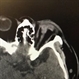 Ruptured globe on CT Ruptured globe on CT