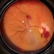 Bilateral Roth Spot in the Setting of Mitral Valve Endocarditis Bilateral Roth Spot in the Setting of Mitral Valve Endocarditis