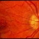 Pseudotumor Cerebri Pseudotumor Cerebri
