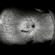 Proliferative Diabetic Retinopathy after PRP Laser Treatment