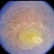Leber's Congenital Amaurosis