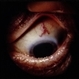 Ciliary Body Choroidal Melanoma Ciliary Body Choroidal Melanoma