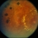 Macroaneurysm with Laser Macroaneurysm with Laser