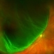 Large Retinal Detachment Large Retinal Detachment