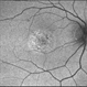 03- Unilateral Acute Idiopathic Maculopathy (UAIM) - FAF OD 03- Unilateral Acute Idiopathic Maculopathy (UAIM) - FAF OD