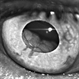 Large Ciliochoroidal Melanoma Diagnosed During Cataract Surgery Large Ciliochoroidal Melanoma Diagnosed During Cataract Surgery