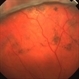 Pigment Fallout After Scleral Buckle Pigment Fallout After Scleral Buckle