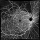 Branch Retinal Vein Occlusion with Macular Edema Branch Retinal Vein Occlusion with Macular Edema