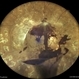 Lasered Profilerative Diabetic Retinopathy Lasered Profilerative Diabetic Retinopathy