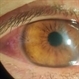 Acute Anterior Uveitis
